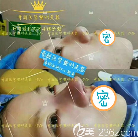 攀枝花奇麗整形美容醫(yī)院鼻綜合術(shù)后即刻效果 攀枝花奇麗整形美容醫(yī)院鼻綜合術(shù)后即刻效果