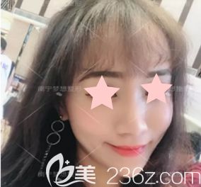  看了自己在南寧夢想整形打瘦臉除皺瘦臉+玻尿酸前后對比照片，感覺挺靠譜