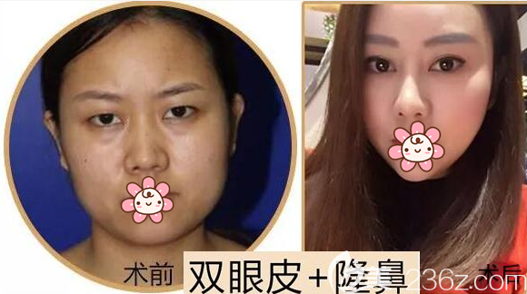 選擇了口碑不錯的攀枝花奇麗整形美容醫(yī)院，雙眼皮隆鼻術(shù)后我女人味十足