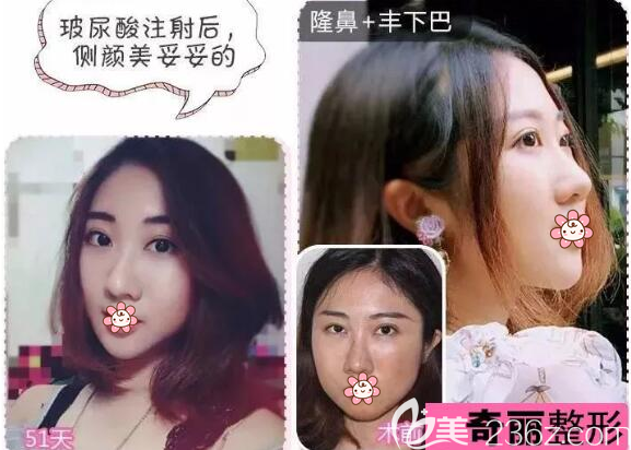 攀枝花奇麗隆鼻豐下巴真實(shí)案例