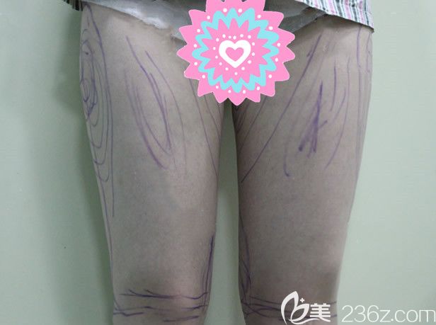 蘭州時光相伴整形美容醫(yī)院大腿吸脂前 蘭州時光相伴整形美容醫(yī)院大腿吸脂前