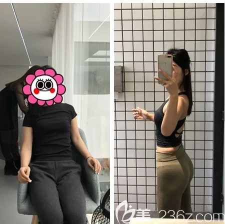 廣州藝美張濤做的大腿和腰腹部吸脂案例