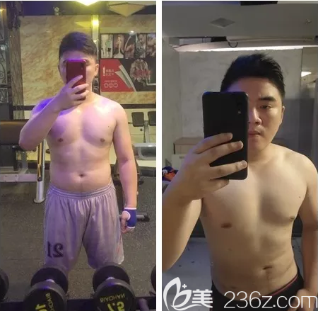 廣州藝美男性腰腹部吸脂案例