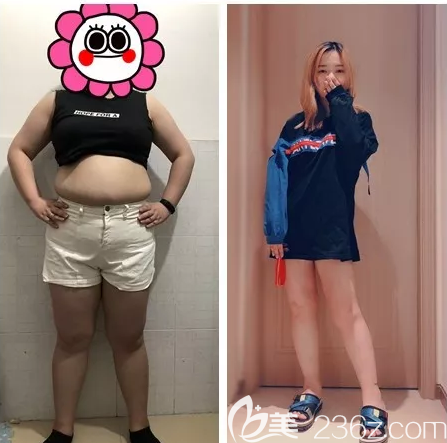 廣州藝美張濤腰腹部吸脂案例