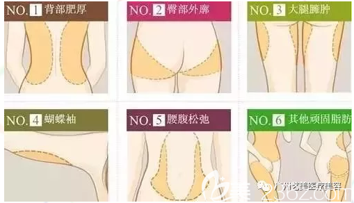 廣州藝美吸脂部位圖