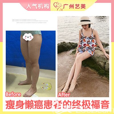 廣州藝美張濤做的大腿吸脂案例