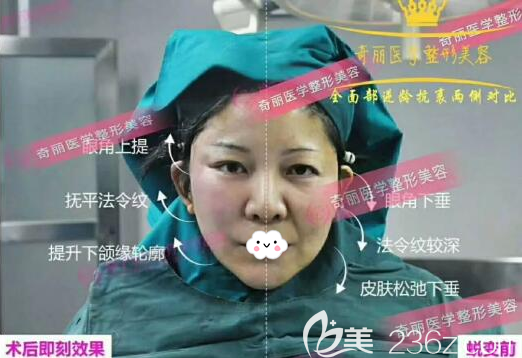 線雕提升抗衰術(shù)中兩側(cè)臉對比