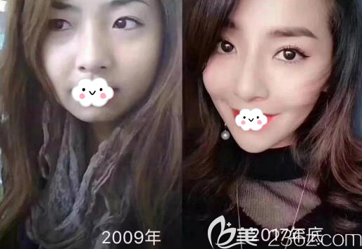 攀枝花奇麗瘦臉+玻尿酸豐下巴術(shù)后效果