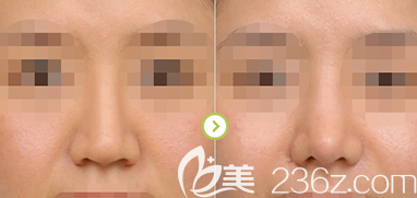 黃寅守隆鼻案例