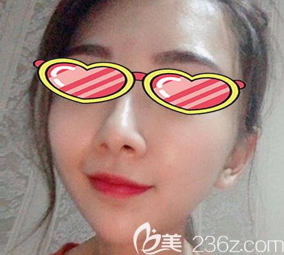 蘭州時光相伴自體脂肪豐太陽穴、額頭第15天<span style=