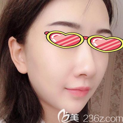 自體脂肪面部填充兩個月<span style=