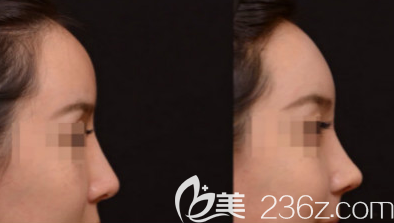 某徐姓醫(yī)生隆鼻案例