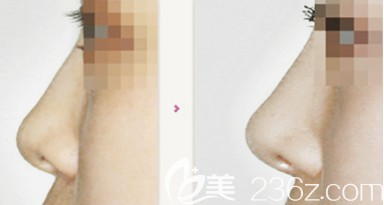 劉彥軍醫(yī)生隆鼻案例