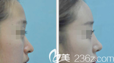 巫文云隆鼻案例