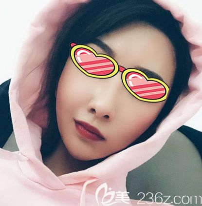 面部凹陷干癟又顯老 找蘭州時光相伴整形張曉萍院長做自體脂肪面部填充后成氣質(zhì)女神