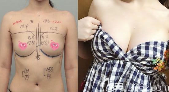 美國曼托假體300cc隆胸