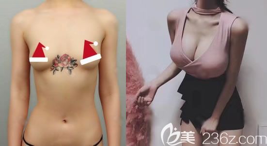 美國曼托水滴型假體350cc