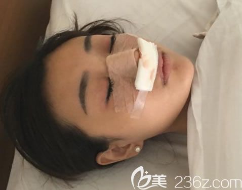 寧波薇琳醫(yī)院做隆鼻即刻<span style=