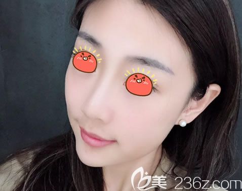 寧波薇琳整形做隆鼻2周<span style=