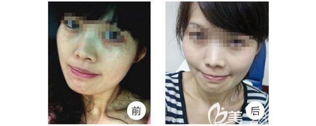 金良夏醫(yī)生祛斑案例 金良夏醫(yī)生祛斑案例