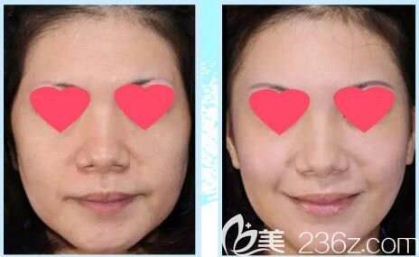 金良夏醫(yī)生除皺案例對(duì)比 金良夏醫(yī)生除皺案例對(duì)比