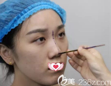 荊萬里醫(yī)生為我做鼻綜合術(shù)前設計 荊萬里醫(yī)生為我做鼻綜合術(shù)前設計