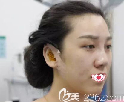 荊萬里醫(yī)生為我做鼻綜合術(shù)后鼻子微腫 荊萬里醫(yī)生為我做鼻綜合術(shù)后鼻子微腫