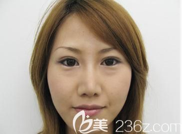 一不小心到日本水之森做了雙眼皮整形和鼻尖縮小術(shù) 效果居然不可思議