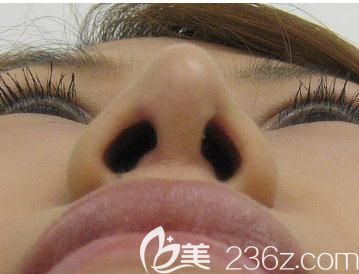 水之森鼻尖縮小術(shù)后