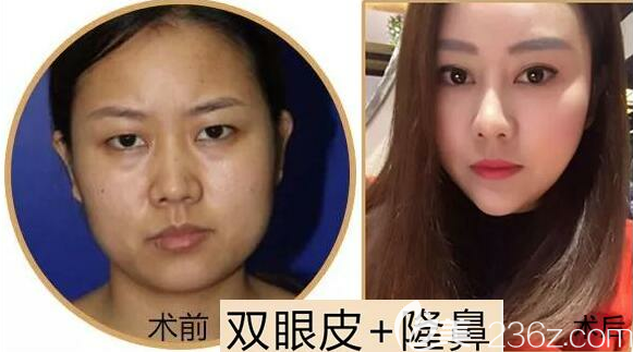 攀枝花奇麗雙眼皮隆鼻手術(shù)效果展示