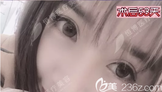 帕克法雙眼皮恢復(fù)2個(gè)月照片 帕克法雙眼皮恢復(fù)2個(gè)月照片