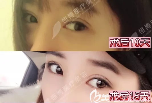 成都恒博雙眼皮術(shù)后半個(gè)月恢復(fù)效果圖 成都恒博雙眼皮術(shù)后半個(gè)月恢復(fù)效果圖