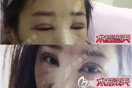 成都恒博切開雙眼皮術(shù)后即刻 成都恒博切開雙眼皮術(shù)后即刻