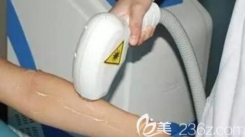 激光脫毛的過(guò)程