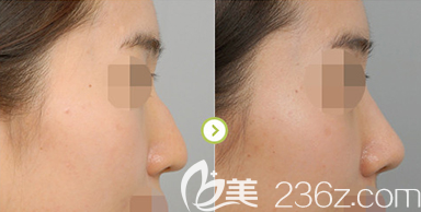 西安壹加壹隆鼻案例