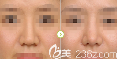 西安畫美隆鼻案例