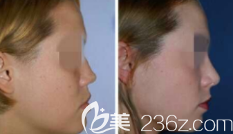 西安高一生隆鼻案例