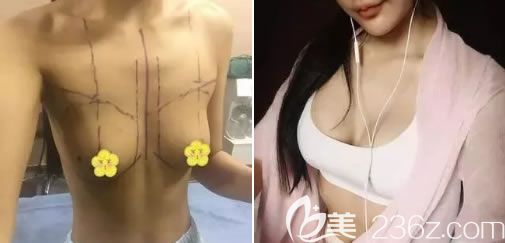 225cc妙桃假體隆胸案例