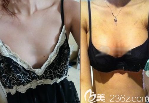 300cc妙桃假體隆胸案例圖