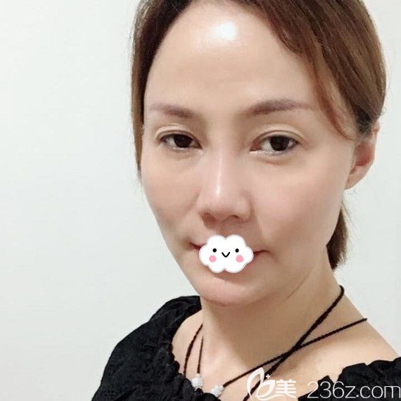 武漢面部年輕化哪家醫(yī)院好？美基元線雕案例