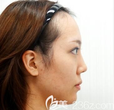 誰去日本做過下巴整形？關(guān)于我去日本水之森做硅膠假體墊下巴經(jīng)歷的一段回憶