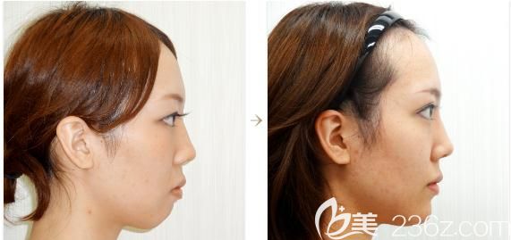 日本水之森做假體墊下巴側(cè)面前后對(duì)比