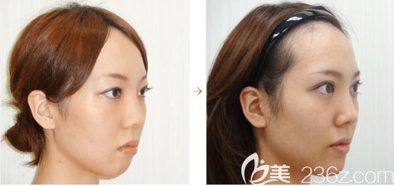 日本水之森做假體墊下巴正側(cè)面對(duì)比