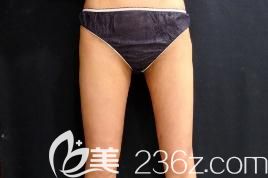 水之森末永裕信吸脂瘦大腿后一個月