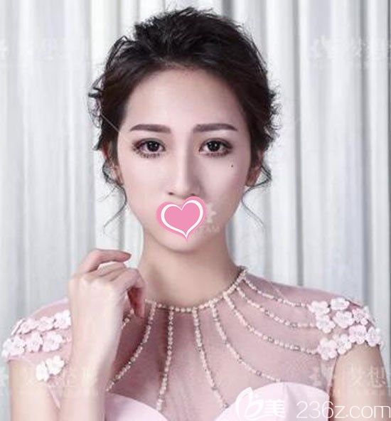 全切雙眼皮+開眼角一個月后恢復效果圖