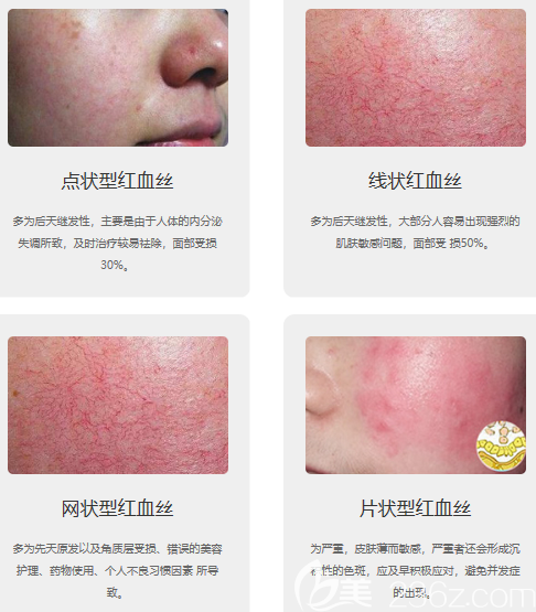 4大類型紅血絲 4大類型紅血絲