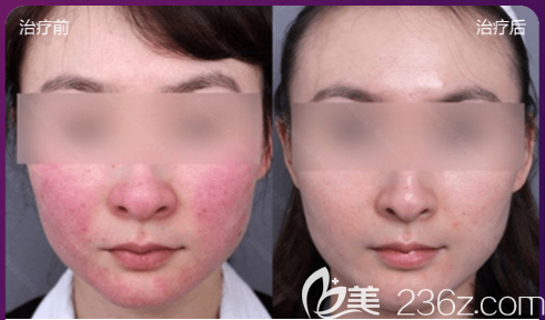 貴陽美貝爾去紅血絲怎么樣 貴陽美貝爾去紅血絲怎么樣