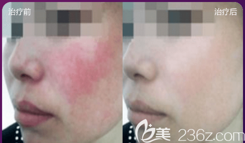 貴陽美貝爾王和平祛紅血絲案例 貴陽美貝爾王和平祛紅血絲案例