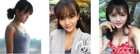 貴陽美貝爾假體隆胸案例 貴陽美貝爾假體隆胸案例