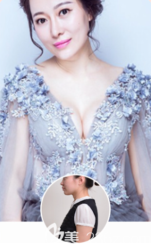 貴陽美貝爾宋俊輝假體豐胸案例 貴陽美貝爾宋俊輝假體豐胸案例